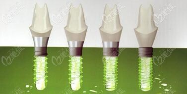 瑞士iti种植体 瑞士iti种植体