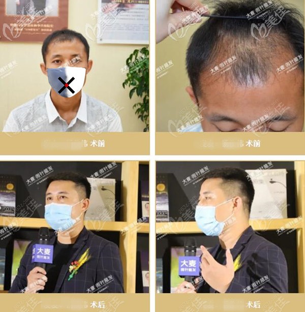 植发十年后会变成怎样?这份微针植发10年以上案例效果回给你答案