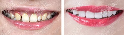 美加瓷贴面可以遮住轻中度氟斑牙