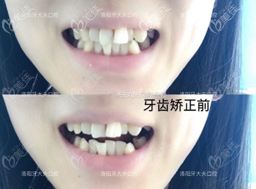 牙齿矫正前 牙齿矫正前