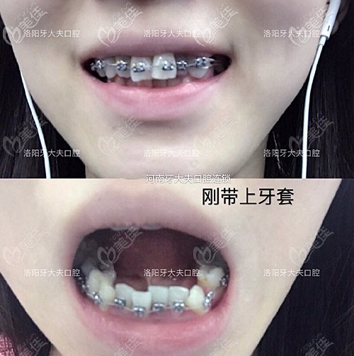 刚带上牙套的效果 刚带上牙套的效果