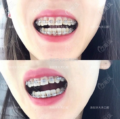 牙齿矫正半年效果 牙齿矫正半年效果