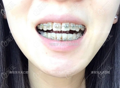 牙齿拥挤门牙被挤的外凸,在洛阳牙大夫戴金属托槽矫正不到1年牙就齐了