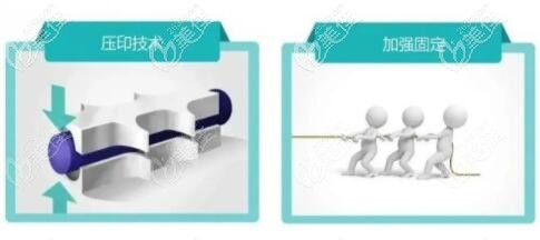 秘特埋植线3D立体压印技术优势