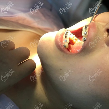 多大就能做牙齿矫正了呢？看这组未成年的整牙案例就能了解