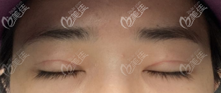 闭眼时候的6.5毫米宽度