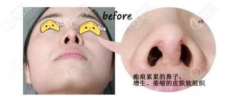 隆鼻失败出现挛缩的鼻子