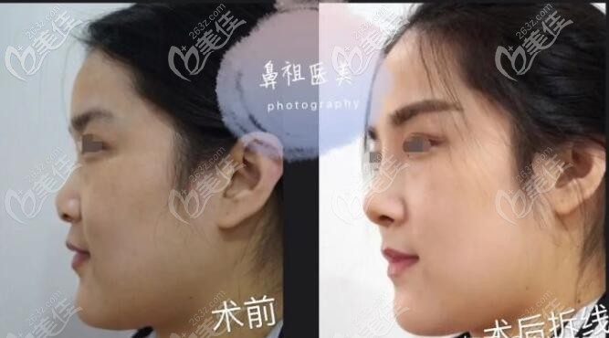 王刚医生挛缩鼻修复前后对比案例
