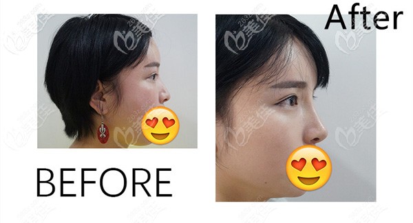 王院长做隆胸的效果展示