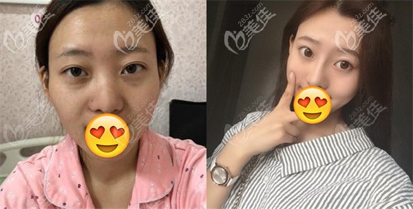 找沈院长做全肋软骨隆鼻术前术后效果