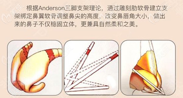 沈正宇医生做隆鼻的手术原理