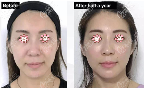 蓝钻鱼骨线全脸提升案例图 蓝钻鱼骨线全脸提升案例图