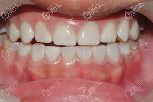 我的四环素牙在福州三颗牙做了全瓷牙贴面终于变白了，给你们看看效果