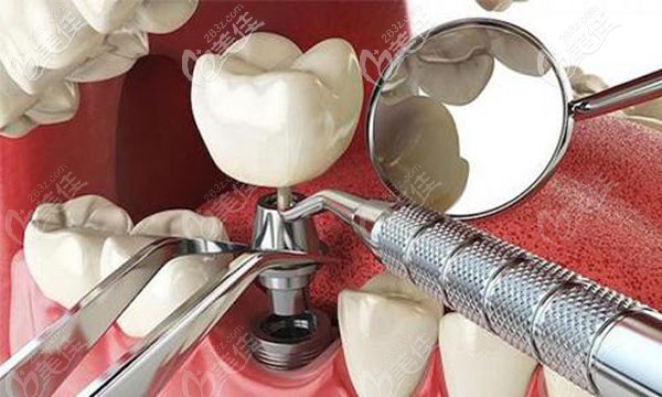 洋紫荆口腔微创种植牙技术优势