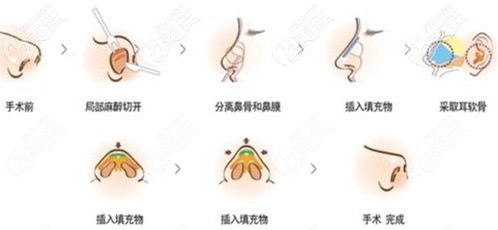 连桂宾医生做耳软骨隆鼻过程