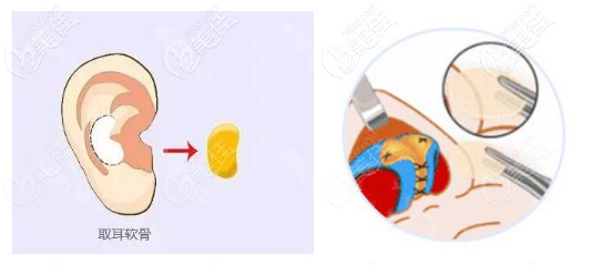 宁波壹加壹林勇医生做耳软骨鼻综特色