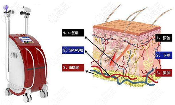热拉提治疗图示 热拉提治疗图示