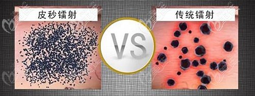 755蜂巢皮秒激光祛斑的优势 755蜂巢皮秒激光祛斑的优势