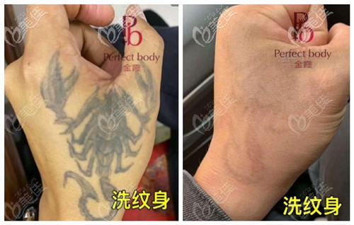 蜂巢皮秒洗纹身的效果前后对比 蜂巢皮秒洗纹身的效果前后对比