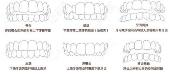 牙齿需要做矫正的几种情况