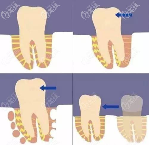 石家庄美年美华口腔做隐形矫正恢复过程