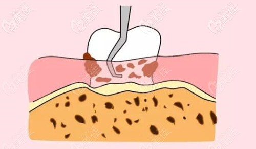 龈下刮治的原理