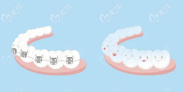 金属托槽和隐形牙套都建议做全口矫正