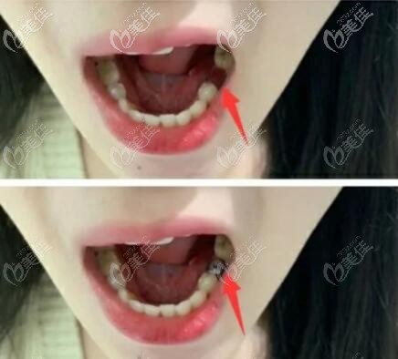 美国百康种植牙案例效果 美国百康种植牙案例效果