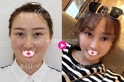 在长沙雅美做热玛吉术前术后效果对比 在长沙雅美做热玛吉术前术后效果对比