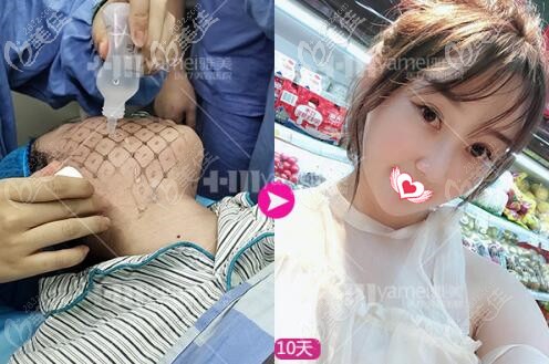 热玛吉治疗过程与术后10天效果照 热玛吉治疗过程与术后10天效果照