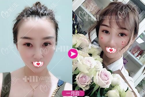 做热玛吉全脸1个月时的效果照 做热玛吉全脸1个月时的效果照