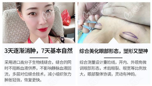 深圳艺星整形黄海侠医生双眼皮优势 深圳艺星整形黄海侠医生双眼皮优势