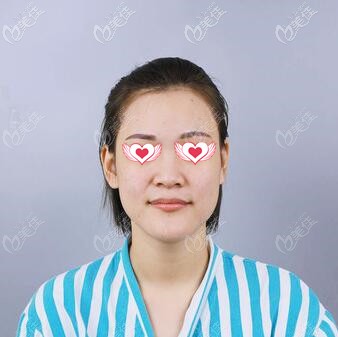 做假体隆鼻术前照 做假体隆鼻术前照