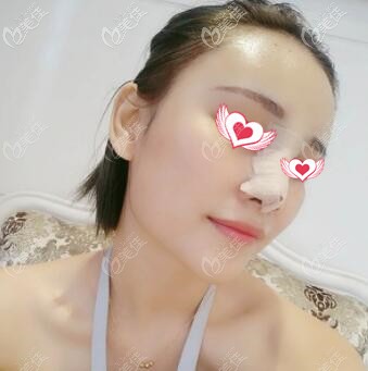 假体隆鼻+脂肪丰太阳穴第3天 假体隆鼻+脂肪丰太阳穴第3天