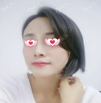 假体隆鼻术后1周拆线 假体隆鼻术后1周拆线