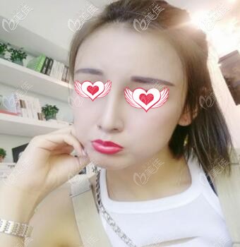 假体隆鼻脂肪填充太阳穴术后1个月效果照 假体隆鼻脂肪填充太阳穴术后1个月效果照