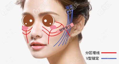 韩胜医生做面部埋线提升的优势