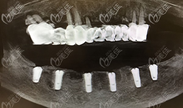 6颗植体就能完成下半口牙缺失的修复,评价下杭州美莱口腔种植技术吧