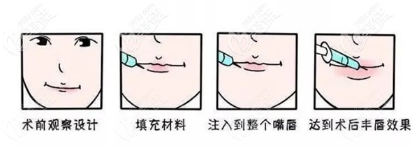 玻尿酸丰唇手术步骤