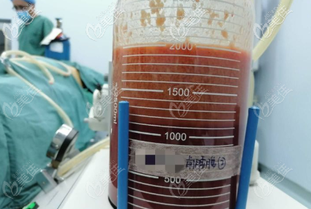 看我2000CC的脂肪量