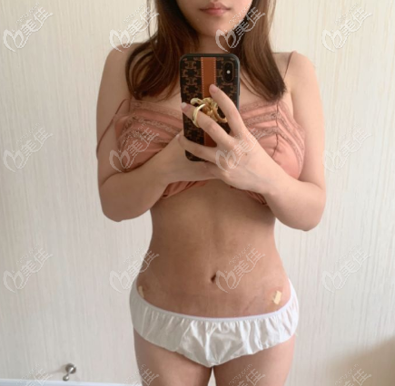 我做完腰部吸脂后使胯骨变窄了，一个月的效果图奉上供参考