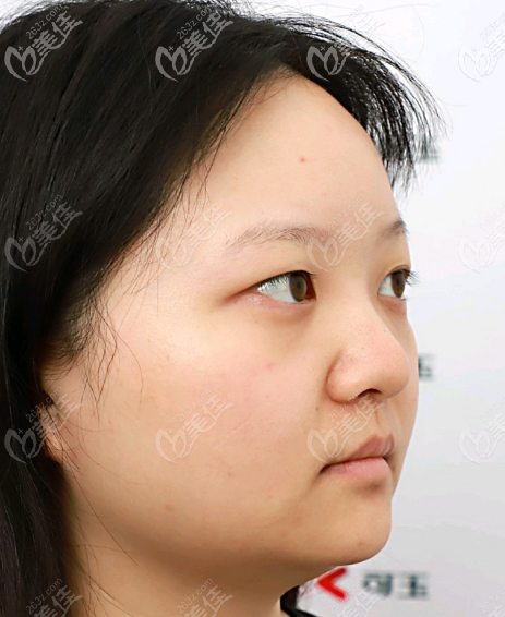 广州可玉整形医院双眼皮案例术前照片 广州可玉整形医院双眼皮案例术前照片