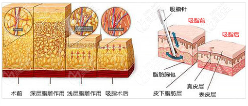 广州壹加壹黄文谊医生吸脂优势