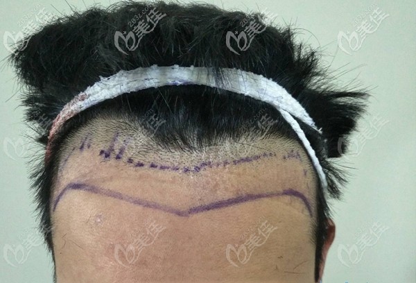 男士发际线种植术前照 男士发际线种植术前照
