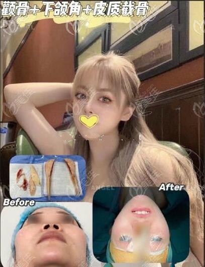 韩国医生吉玟锡磨骨案例效果对比图 韩国医生吉玟锡磨骨案例效果对比图