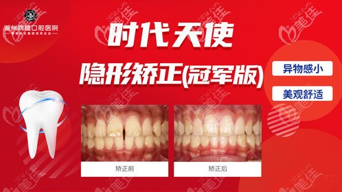 湖州鼎植做牙齿矫正价格贵吗