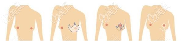 双环法乳房悬吊术操作过程图解