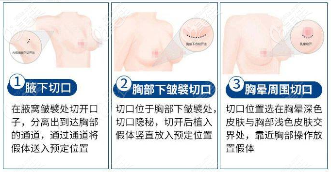 湛江澳泰整形医院隆胸优势