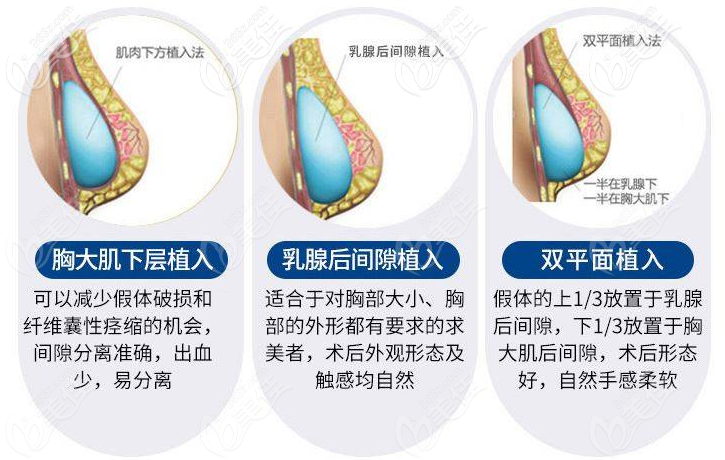 湛江澳泰整形医院隆胸植入层次<span style=