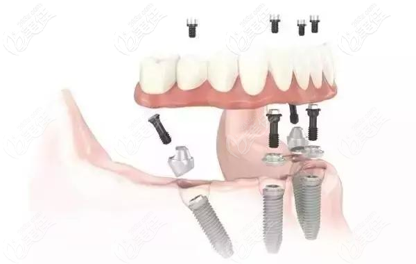 福州贝臣口腔登腾Allon4种植牙技术